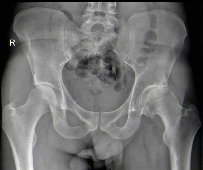 Radiografia da bacia mostrando artrose de anca